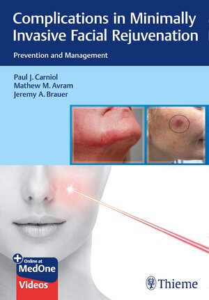 Buchcover Complications in Minimally Invasive Facial Rejuvenation | Paul J. Carniol | EAN 9781684200139 | ISBN 1-68420-013-X | ISBN 978-1-68420-013-9