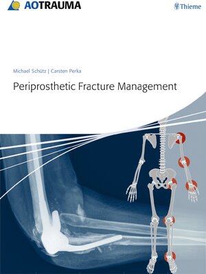 Buchcover Periprosthetic Fracture Management | Michael Schütz | EAN 9783131715111 | ISBN 3-13-171511-1 | ISBN 978-3-13-171511-1