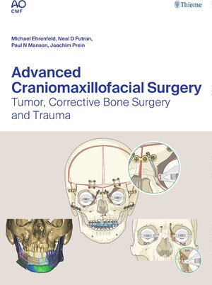 Buchcover Advanced Craniomaxillofacial Surgery  | EAN 9783132428409 | ISBN 3-13-242840-X | ISBN 978-3-13-242840-9