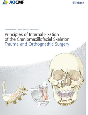 Buchcover Principles of Internal Fixation of the Craniomaxillofacial Skeleton | Michael Ehrenfeld | EAN 9783132453180 | ISBN 3-13-245318-8 | ISBN 978-3-13-245318-0