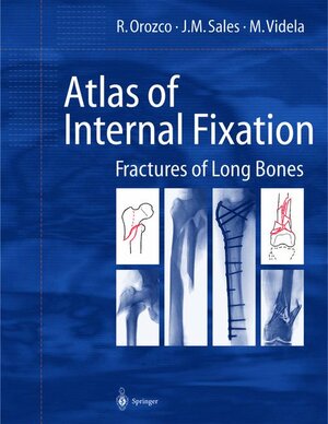Buchcover Atlas of Internal Fixation | R. Orozco | EAN 9783540656210 | ISBN 3-540-65621-9 | ISBN 978-3-540-65621-0