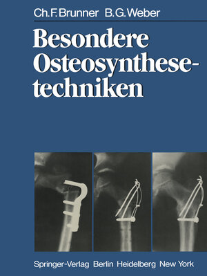 Buchcover Besondere Osteosynthesetechniken | C. F. Brunner | EAN 9783642931802 | ISBN 3-642-93180-4 | ISBN 978-3-642-93180-2