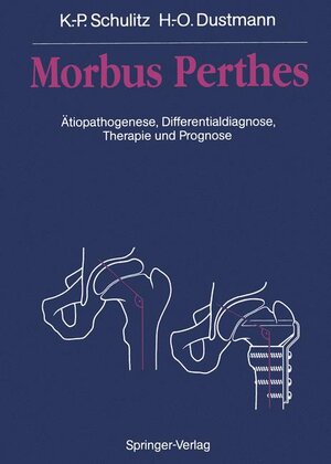 Buchcover Morbus Perthes | Klaus-Peter Schulitz | EAN 9783642978630 | ISBN 3-642-97863-0 | ISBN 978-3-642-97863-0