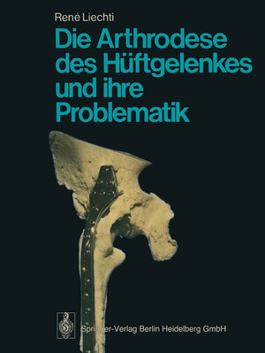 Buchcover Die Arthrodese des Hüftgelenkes und ihre Problematik | R. Liechti | EAN 9783662066263 | ISBN 3-662-06626-2 | ISBN 978-3-662-06626-3