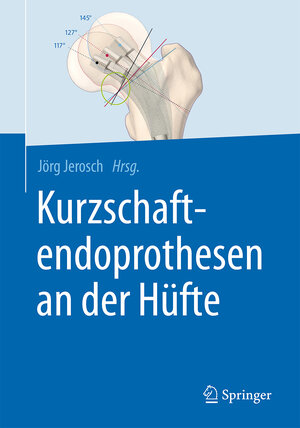 Buchcover Kurzschaftendoprothesen an der Hüfte  | EAN 9783662527436 | ISBN 3-662-52743-X | ISBN 978-3-662-52743-6