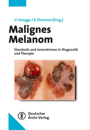 Malignes Melanom: Standards und Innovationen in Diagnostik und Therapie