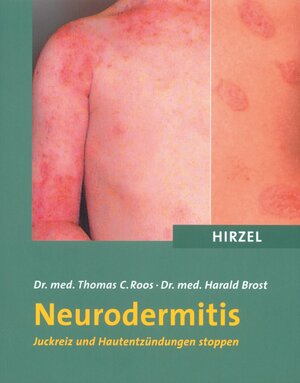 Buchcover Neurodermitis | Thomas C. Roos | EAN 9783777612638 | ISBN 3-7776-1263-4 | ISBN 978-3-7776-1263-8