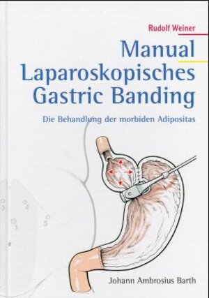 Manual Laparoskopisches Gastric Banding