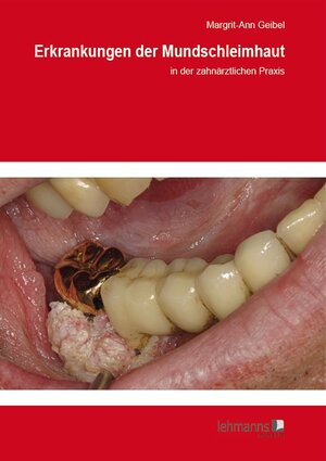 Buchcover Erkrankungen der Mundschleimhaut | Margrit-Ann Geibel | EAN 9783865416896 | ISBN 3-86541-689-6 | ISBN 978-3-86541-689-6