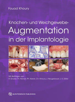 Buchcover Knochen- und Weichgewebeaugmentation in der Implantologie  | EAN 9783868677225 | ISBN 3-86867-722-4 | ISBN 978-3-86867-722-5