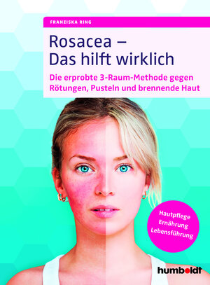 Buchcover Rosacea – Das hilft wirklich | Franziska Ring | EAN 9783869100531 | ISBN 3-86910-053-2 | ISBN 978-3-86910-053-1