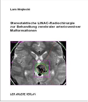 Stereotaktische LINAC-Radiochirurgie zur Behandlung zerebraler arteriovenöser Malformationen