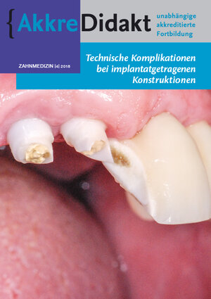 Buchcover Technische Komplikationen bei implantatgetragenen Konstruktionen | Gordon van der Avoort | EAN 9783910487086 | ISBN 3-910487-08-4 | ISBN 978-3-910487-08-6
