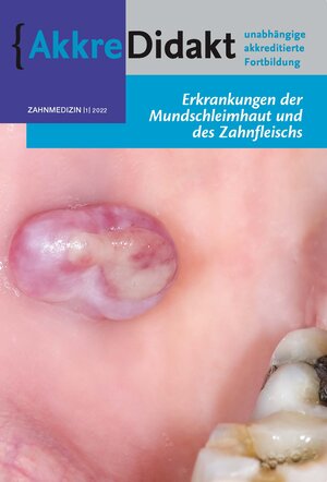 Buchcover Erkrankung der Mundschleimhaut und des Zahnfleisches | Isaäc van der Waal | EAN 9783910487215 | ISBN 3-910487-21-1 | ISBN 978-3-910487-21-5