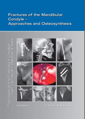 Buchcover Fractures of the Mandibular Condyle - Approaches and Osteosynthesis | U. Eckelt | EAN 9783920269726 | ISBN 3-920269-72-1 | ISBN 978-3-920269-72-6