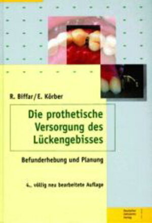 Die prothetische Versorgung des Lückengebisses. Befunderhebung und Planung