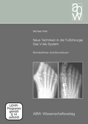 Buchcover Neue Techniken in der Fußchirurgie - Das V-tek-System | Michael Vitek | EAN 9783936072983 | ISBN 3-936072-98-1 | ISBN 978-3-936072-98-3