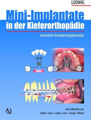 Buchcover Mini-Implantate in der Kieferorthopädie | Björn Ludwig | EAN 9783938947470 | ISBN 3-938947-47-0 | ISBN 978-3-938947-47-0