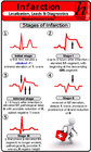 Buchcover Infarction Localization, Leads & Diagnostics